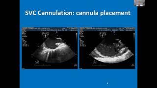 Echocardiography In ECMO by Dr Rajesh Arya