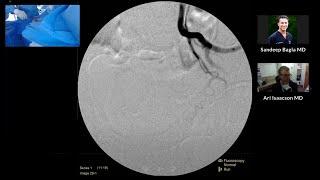 TruSelect™ Microcatheter Live Case Recording