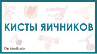 Кисты яичников: что такое, виды, симптомы, осложнения, принцип лечения