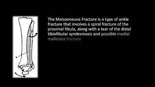 Understanding the Maisonneuve Fracture: Diagnosis, Treatment, and Prognosis - Dr Kathir Stalin