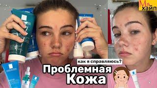 МОЯ ПРОБЛЕМНАЯ КОЖА || снова акне как я справляюсь?