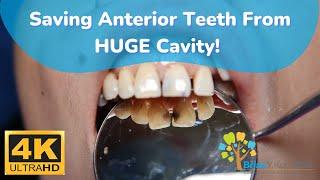 Saving Anterior Teeth From HUGE Cavity!