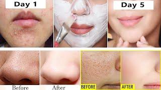 In 5 Days Get Rid of Pimples, Whiteheads, Clogged Pores and Dark Spots - Get Clear Bright Complexion