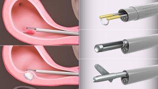 Operative hysteroscopy for polyps and fibroids | TVASurg