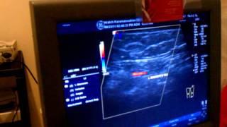 Dr H Karamanoukian - Healed venous ulcer - perforator reflux