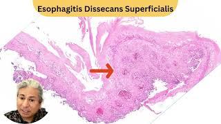 There's nothing more satisfying in the esophagus than this diagnosis! 