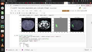 Liver Tumor Segmentation and Classification with 3D U-Net in PyTorch | +91-9872993883 for Queries