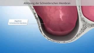 Schonender Knochenaufbau mit Sinuslift - Implantat im Zentrum DDr. Gerald JAHL