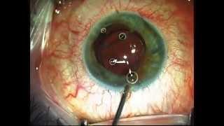 Bright Ocular Iris Implant Aniridia surgery