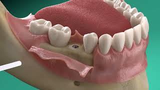 Straumann®️ GalvoSurge®️: Implant surface decontamination in peri-implantitis treatment