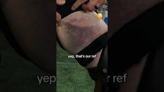 How did a professional ref get THAT bruise?!  #lacrosse #ouch #bruise