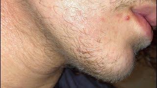 Minoxidil and Derma roller (Week 7) (Month 1)