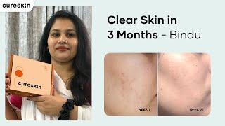 Bindu’s Journey to Clear, Glowing Skin in Just 3 Months with Cureskin | Cureskin