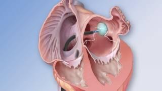 Freezing Heart Muscle - Mayo Clinic