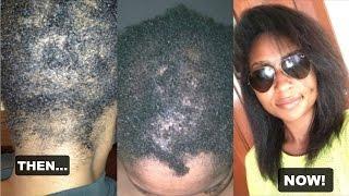 My Hair Loss: Alopecia Areata | JaMexicanBeauty | iamLindaElaine