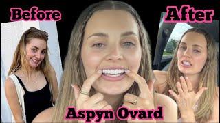 Aspyn Ovard Got VENEERS….before & after