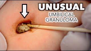 UNUSUAL UMBILICAL GRANULOMA (Cauterized With Silver Nitrate) | Dr. Paul