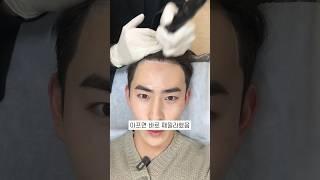 M자 탈모 있는 분들.. 진짜 한 번 고민해 보세요