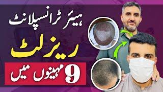 Transformative Hair Transplant 9-Months Results | Extraordinary Result | Dr. Habib