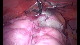 Laparoscopic Tissue Removal without music
