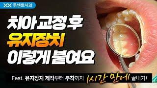 교정이 끝나도 끝난게 아니다? 교정 유지 장치 부착과정 | Feat. 제작부터 부착까지 1시간!