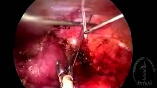 Single-Port Nephrectomy - Ureter retraction