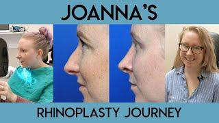 Joanna's Rhinoplasty Journey