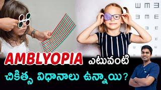 Amblyopia treatment telugu | Amblyopia చికిత్స | Lazy Eye Treatment | Squint eye | Dr.Abdul Rasheed