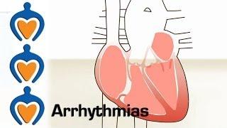 Arrhythmias - What is an arrhythmia and how is it treated?