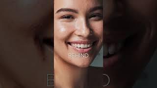ACNE - Root Causes