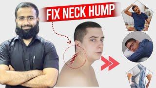 Fix your Bad Neck Posture | Neck Hump correction exercises
