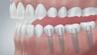 Dental Implant treatment