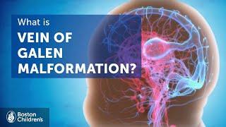 Vein of Galen malformation (VOGM) | Boston Children's Hospital