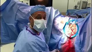 Urethral Diverticulectomy by Dr. Christopher Hollowell