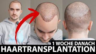 Erste Woche geschafft! Haartransplantation in Deutschland | Hairmedic