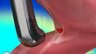 How tongue tie laser works