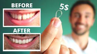 DIY: CLOSE GAP TEETH AT HOME || My Update