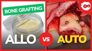 Allo vs Autograft for Dental Implants
