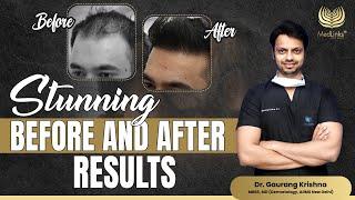 Stunning Before and After Results | Hair Transplant 2024 | MedLinks