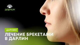 Все виды брекетов в сети стоматологических клиник Дарлин