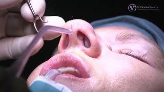 Rinoplastia abierta en Barcelona (video completo de la serie de 6)