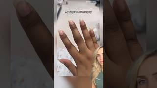 Doctor reacts: finger amputation?!