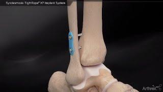 Syndesmosis TightRope® XP Implant System