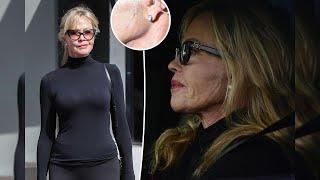 Years after battling skin cancer, Melanie Griffith is pictured with a fresh scar on her face.