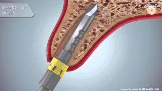 C-TECH EL Immediate Implant placement and loading protocol