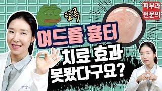 (*Eng) 여드름흉터 없애는법 꼭 보세요!  Acne scar treatment - 피부과전문의 [닥터필러]