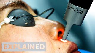 EXPLAINED: PicoSure Pro Laser | London