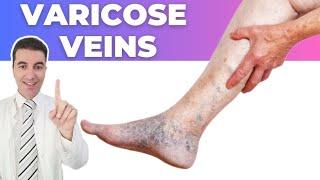 Varicose Veins: Causes, Symptoms and Treatment