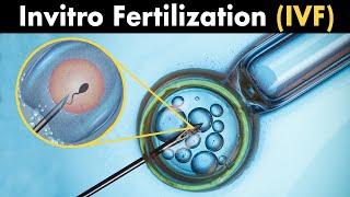 What is InVitro Fertilization? |  (IVF)