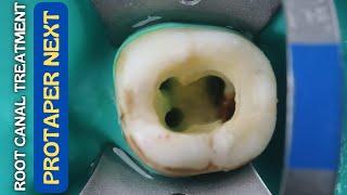 Root Canal Treatment in Mandibular Molar ️ Protaper Next  Step By Step Demonstration
